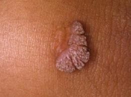 ľudský papilomavírus, čo to je